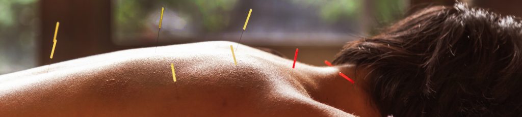 Acupuntura